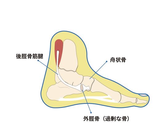 外脛骨の写真